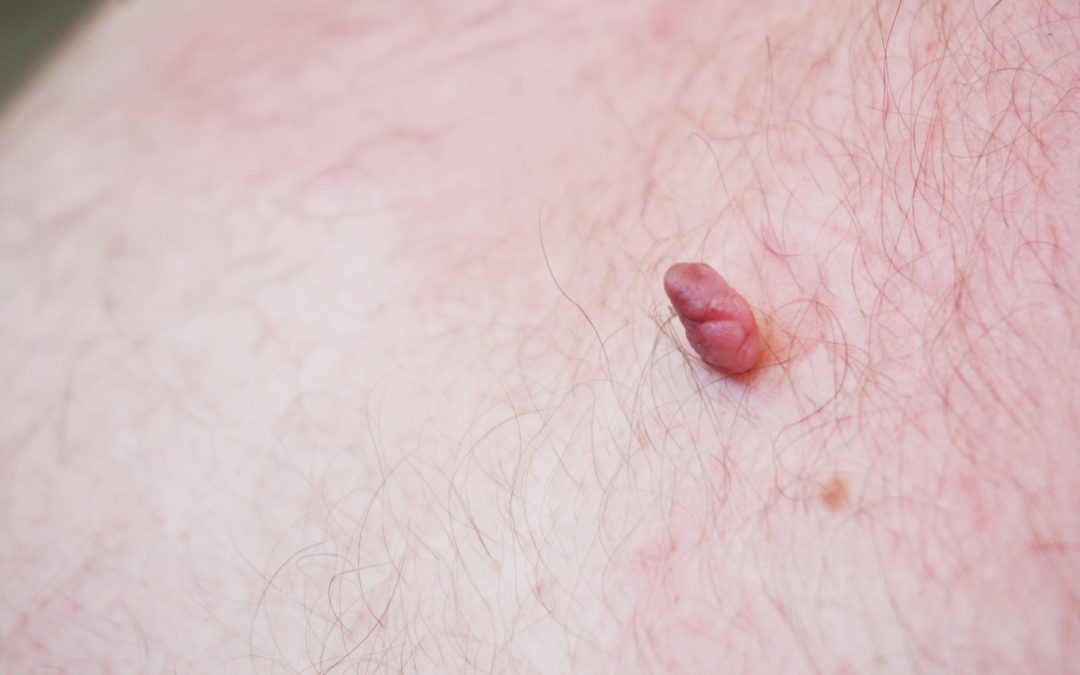 Skin Tag Removal Costs: Why Is It So Expensive?