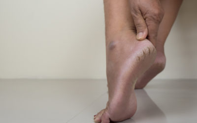 Dry Cracked Heels: 5 Things You Can Do About Them