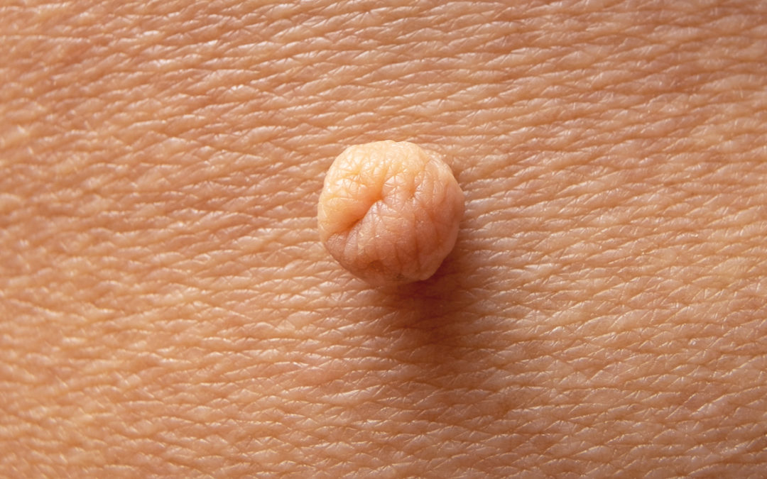 4 Effective Ways to Get Rid of a Skin Tag