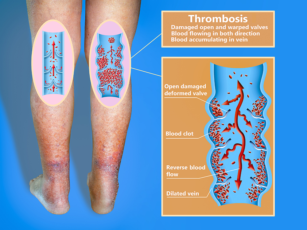 an image explaining thrombosis