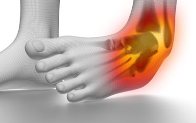 How To Treat a High Ankle Sprain