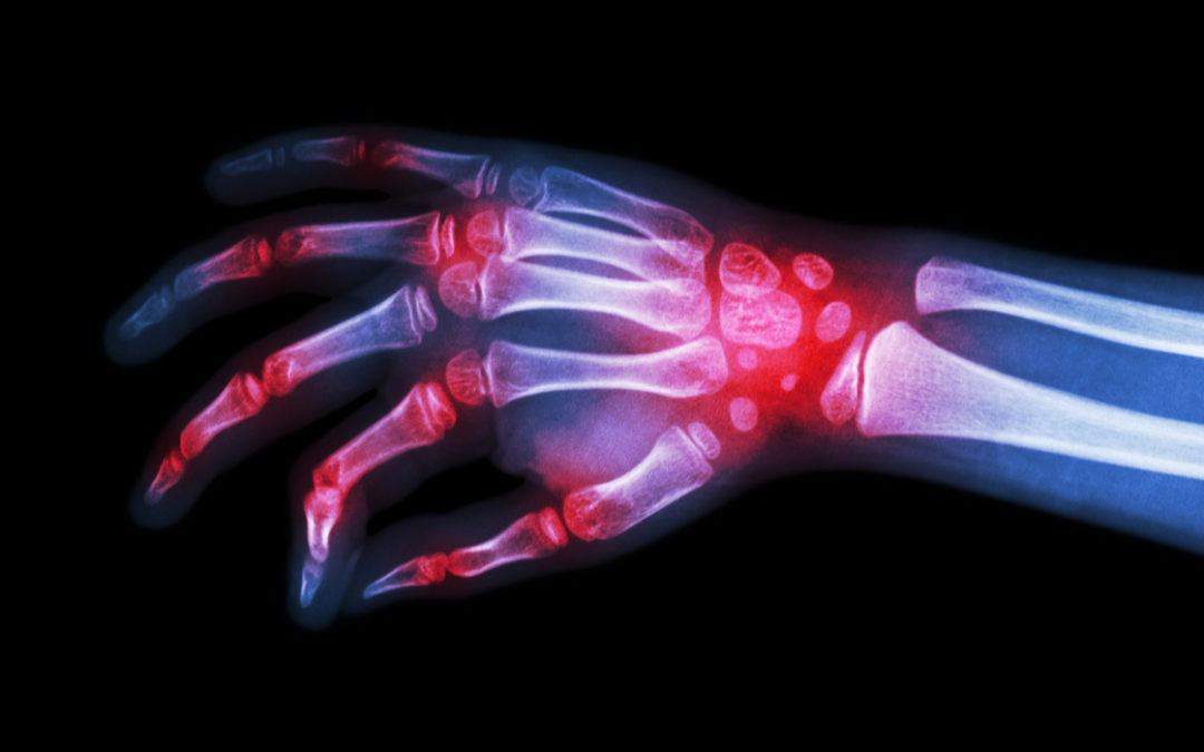 10 Common Types of Arthritis and What You Can Do About Them