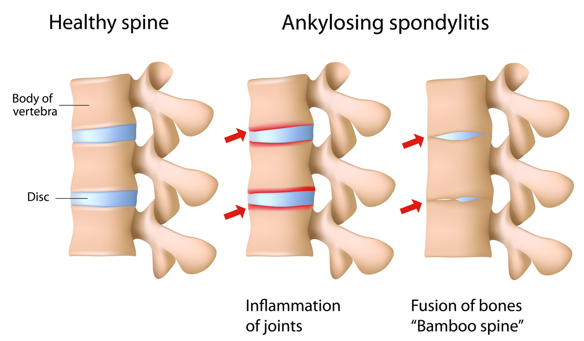 types of spine problems