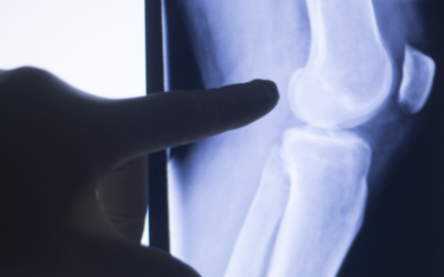 Can Arthritis Be Reversed?