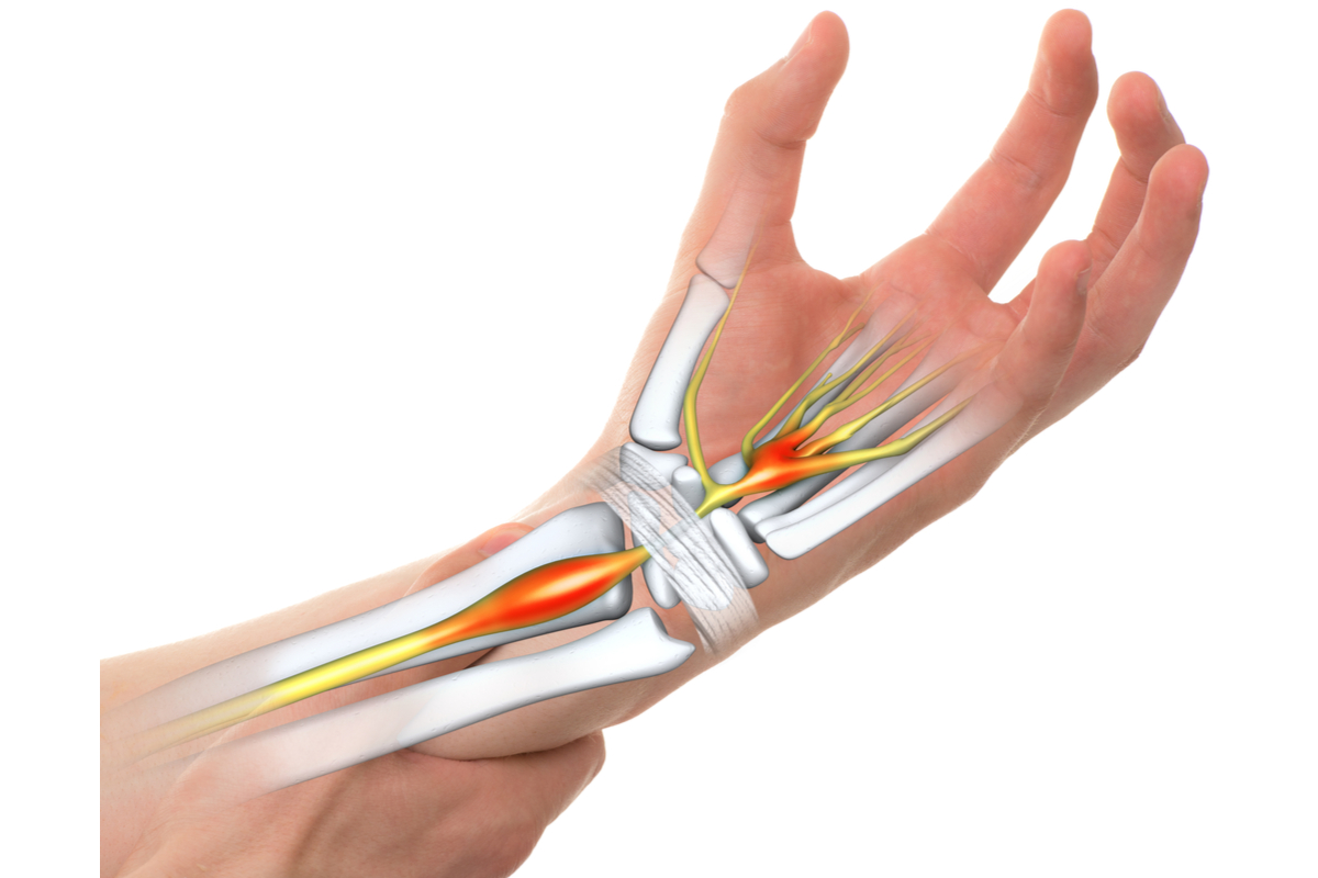 Carpal Tunnel vs. Arthritis What’s the Difference? Hempvana Learning Hub
