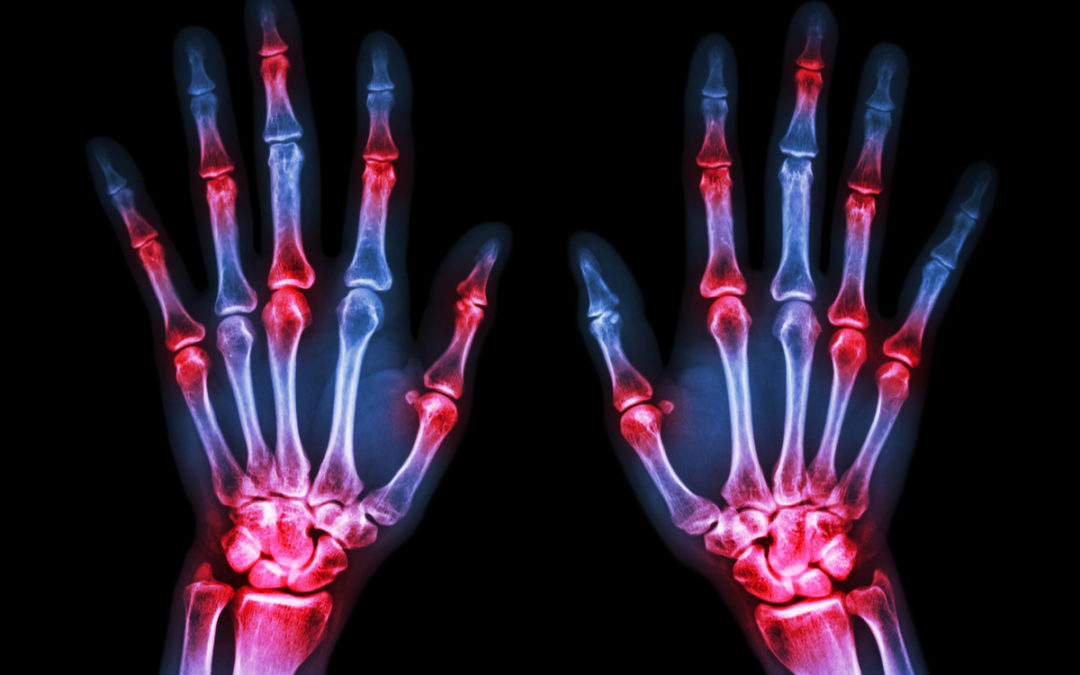 Arthritis vs Arthralgia: What’s the Difference?