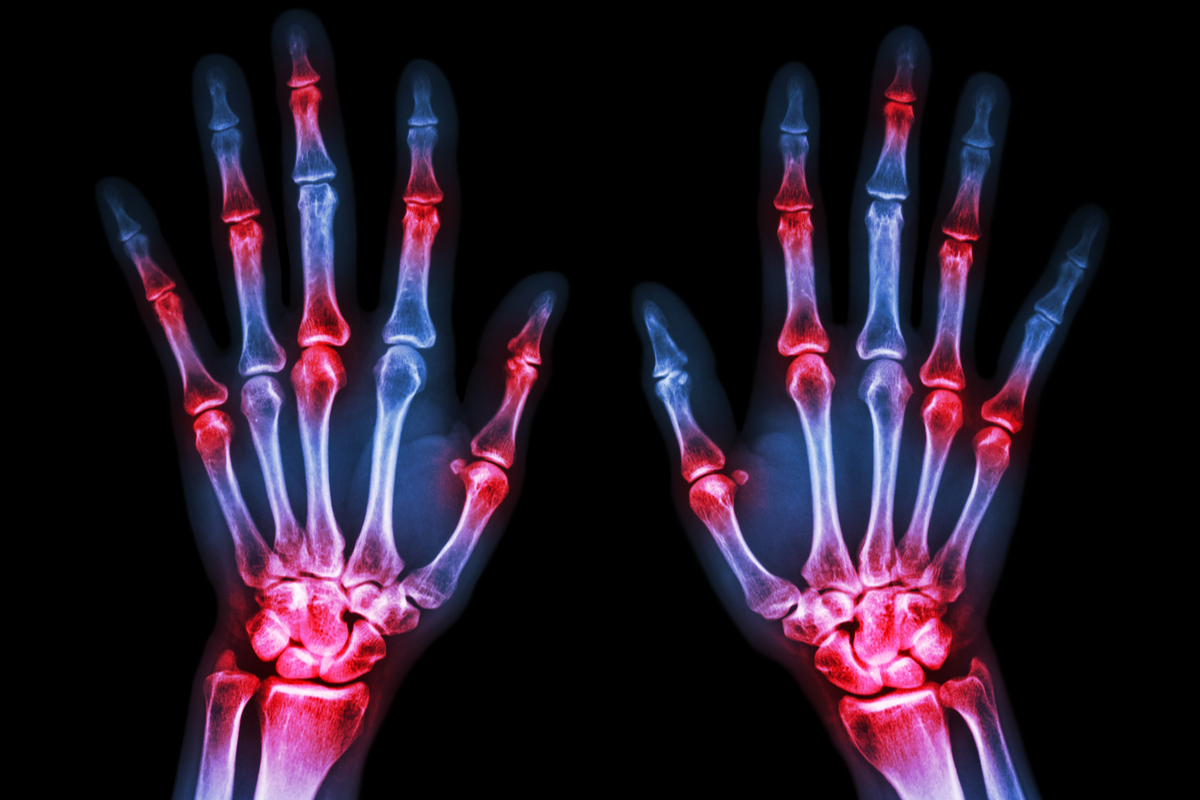 Arthritis vs Arthralgia What’s the Difference? Hempvana Learning Hub
